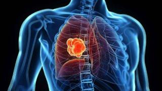 为什么肺癌越来越多？提醒：远离4物，多做3事，肺会逐渐变好