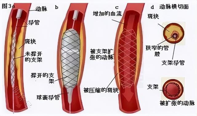 植入心脏支架后就无后顾之忧了吗？我们一起来看看吧