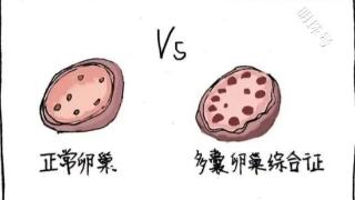 昆明送子鸟：如何备孕才能提高多囊患者的怀孕几率?