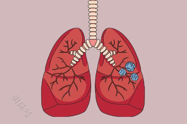 47岁女子长有肺结节，有哪些方法助散结，建议参考下