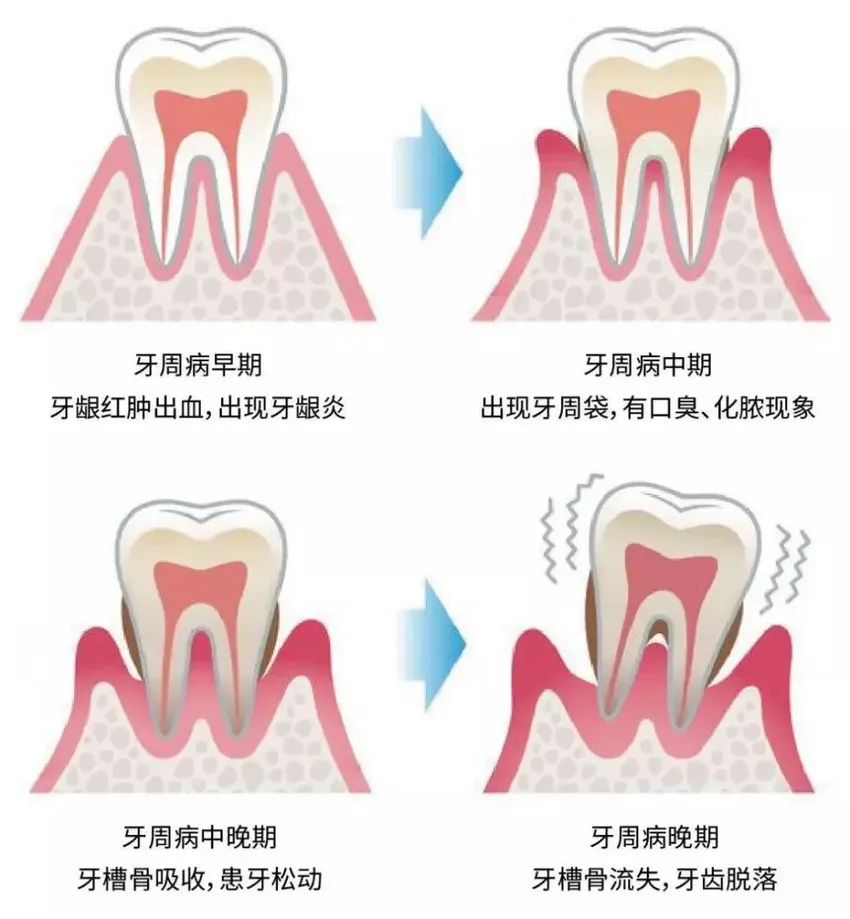 牙周病你了解多少？会出现哪些症状？如何治疗？如何预防？