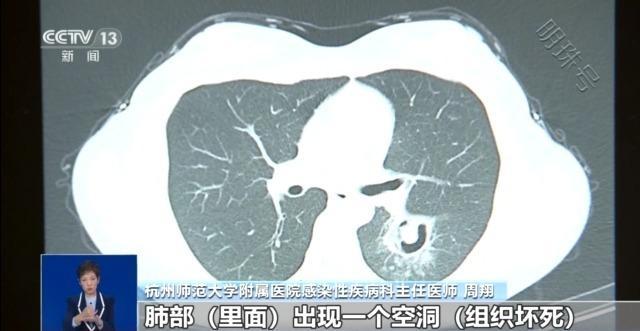 肺部“发霉”！女子高烧三天 竟与清理衣柜有关