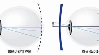 北京爱尔英智眼科医院唐琰：离焦镜真的可以延缓近视进程吗？