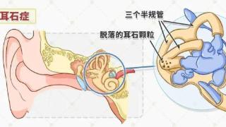 耳石也会“离家出走”？出现这样的症状，警惕耳石症的发生！