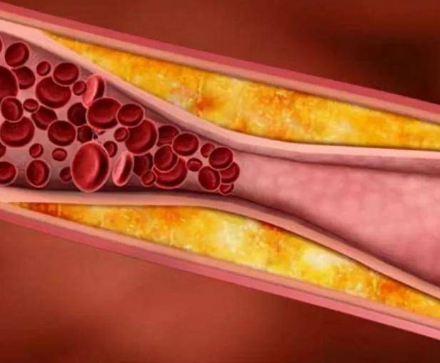 高血脂有3大“克星”，每天吃一些，清血管垃圾，降血脂