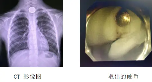 8岁孩子误吞硬币 内镜医生巧“取财”成功脱险