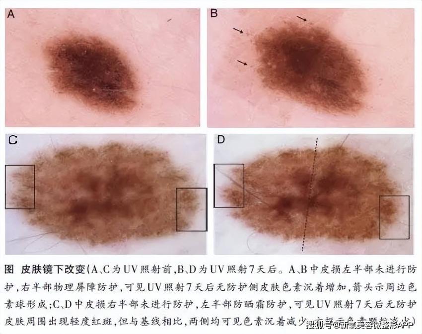 让卡戴珊三姐脸上留大坑差点毁容的痘痘，不管会要人命？