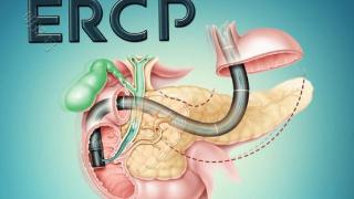 什么是Ercp技术？可以治疗哪些疾病？科普下