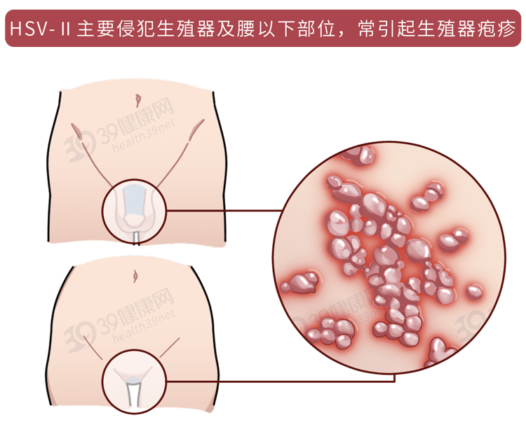 性病种类繁多，症状不同，以下是常见的6类