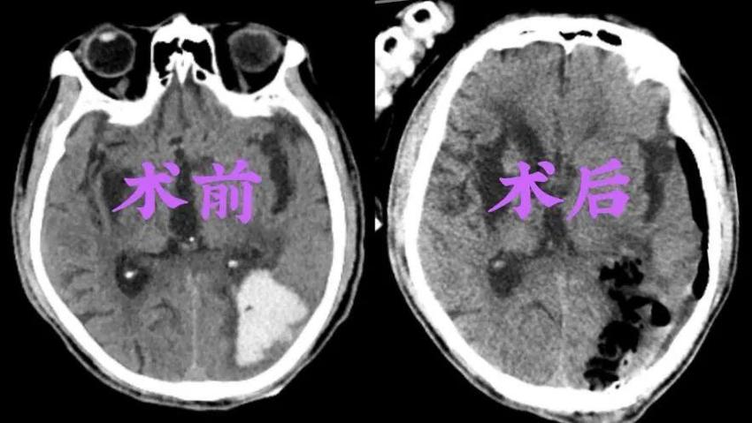 菏泽市牡丹人民医院成功开展“神经内镜”诊疗新技术 让“脑洞”不再大开