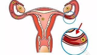 输卵管粘连影响女性生育，该如何才能预防