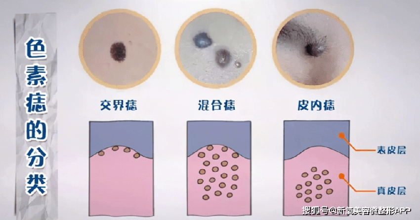 让卡戴珊三姐脸上留大坑差点毁容的痘痘，不管会要人命？