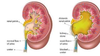 预防肾结石，平时注意这4件事或能避免其发生