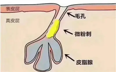 如何拯救皮肤毛孔粗大？