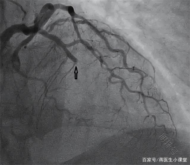 急性心肌梗死的5个原因，可能是急性心肌梗死的发生前兆