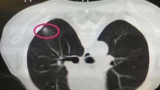 吃茄子会增大肺结节？提醒：想养肺，这3种食物要忌口