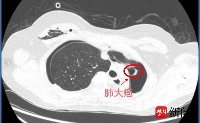 左全肺切除手术，8年时间，肺大疱被完整切除！