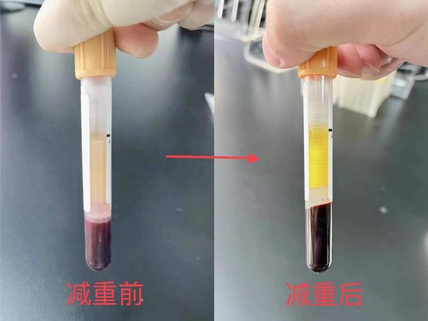 偏好红烧肉吃出“奶茶血”：为了重拥健康 他做了这样的选择