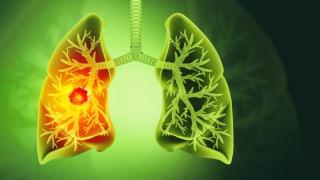 了解肺癌微波消融术：你不得不知的健康信息