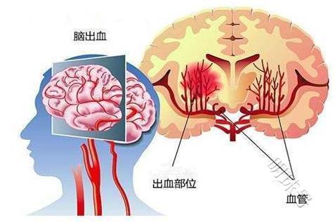 为什么我们国家的人爱得脑出血？一文分析下