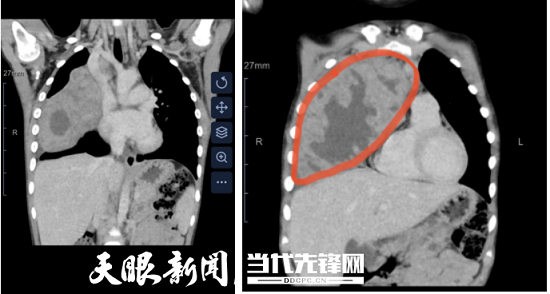 1公斤肿瘤似保龄球！上海儿童医学中心贵州医院、贵州省人民医院医生耗时5小时成功切除