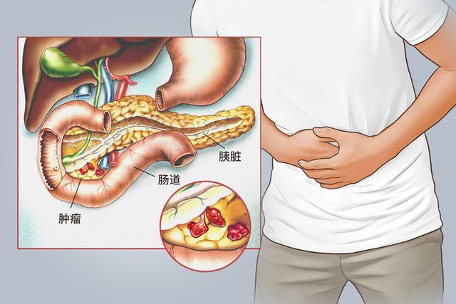 直面“癌王”胰腺癌，预防早筛很重要