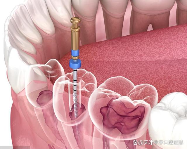 准备根管治疗的朋友一定要看完！