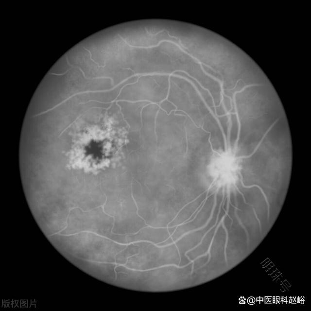 眼科说的黄斑变性是什么？一文揭晓答案