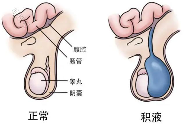 宝宝私处有包块，到底是疝气还是鞘膜积液，分析下