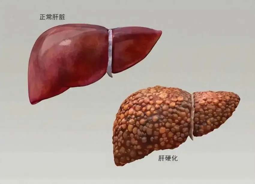 查出肝硬化怎么办？哪些原因引起的？预防肝硬化，从生活细节做起