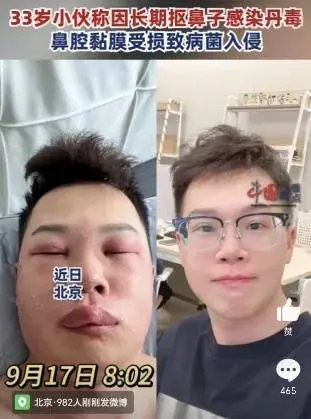 广东一男子腿“烂”到直流脓！医生提醒：夏天做这些事，要当心