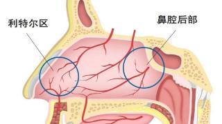 鼻出血多发，该如何正确止鼻血？