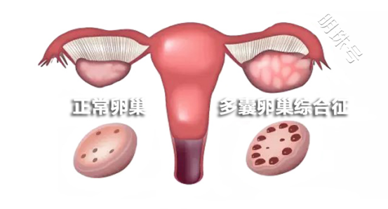 昆明送子鸟：月经不调、体毛多、爆痘……可能是“多囊”找上了门