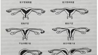 常见的子宫畸形有哪些？