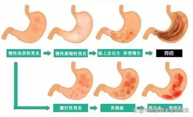 萎缩性胃炎，不要过分关注，也不要放任不管