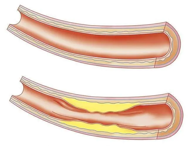 不可忽视的“颈部隐患”：颈动脉斑块！斑块如何形成？如何检测？