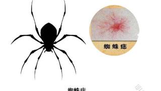 蜘蛛痣的发生，或与肝病有关？科普小知识