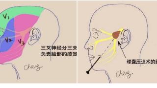 临沂市人民医院微创球囊压迫术治疗灵魂画手的“神针”