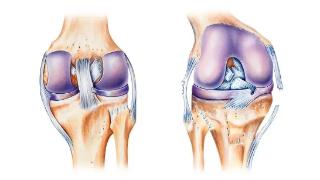 日照市中医医院成功实施双膝关节镜下多发韧带修复手术