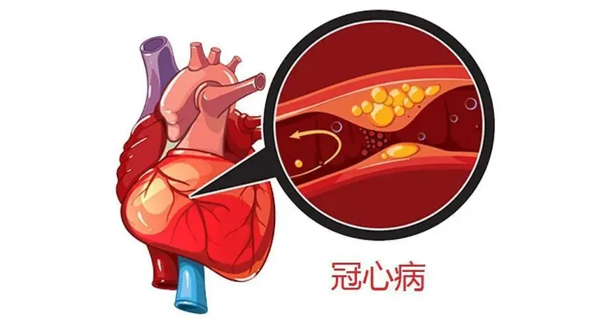 冠心病究竟是哪生病了？日常做好9项预防！一文掌握关键防治