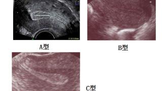 子宫内膜增厚  对妊娠和辅助生殖成功率的影响？