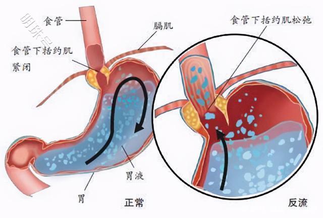 导致浅表性胃炎的因素有哪些？一文了解清楚