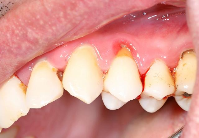 牙齿根部发黄，通过牙齿贴面修复、烤瓷牙修复等方式来改善