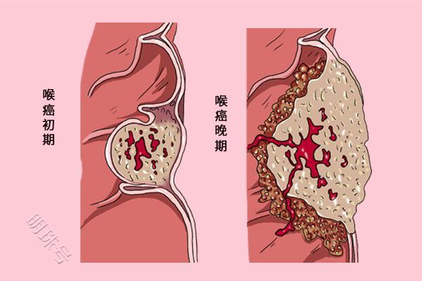 喉癌找上门，身体一般容易出现3个“警报”，别总以为是咽炎