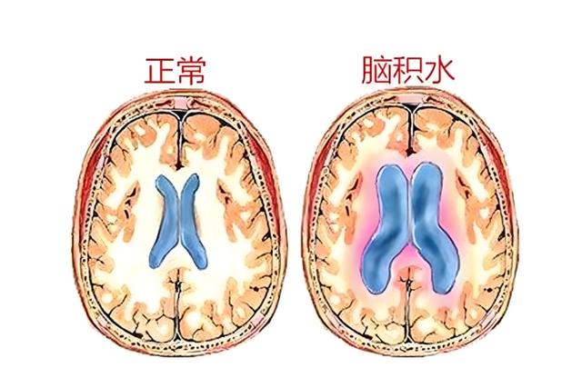 什么是脑积水？有什么症状？