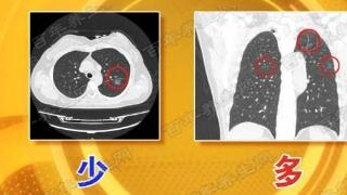 肺结核与肺部结节有哪些区别