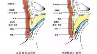 北京好年华大咖问答：双眼皮贴就能实现的效果为什么要做手术？