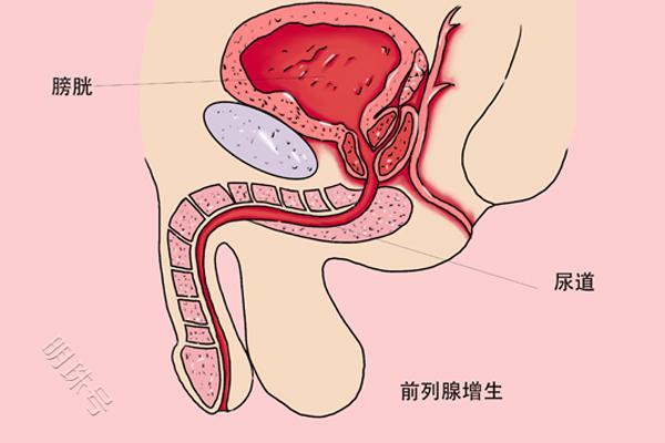 男人想知道自己前列腺好不好，观察自己尿尿就知道