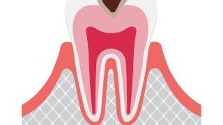 牙齿敏感到底是咋回事？