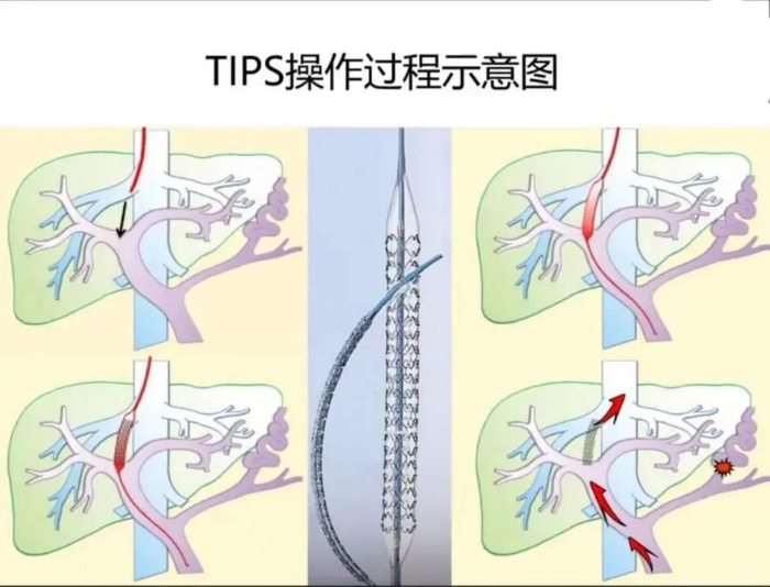 反复消化道出血、腹泻！安徽一医院技术创新为患者成功开展高难度介入手术